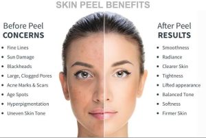 Split-face comparison showing the benefits of a skin peel treatment. The left side displays concerns such as fine lines, sun damage, blackheads, clogged pores, acne scars, age spots, hyperpigmentation, and uneven tone. The right side shows improved skin with smoothness, radiance, clarity, tightness, a lifted appearance, balanced tone, softness, and firmness.