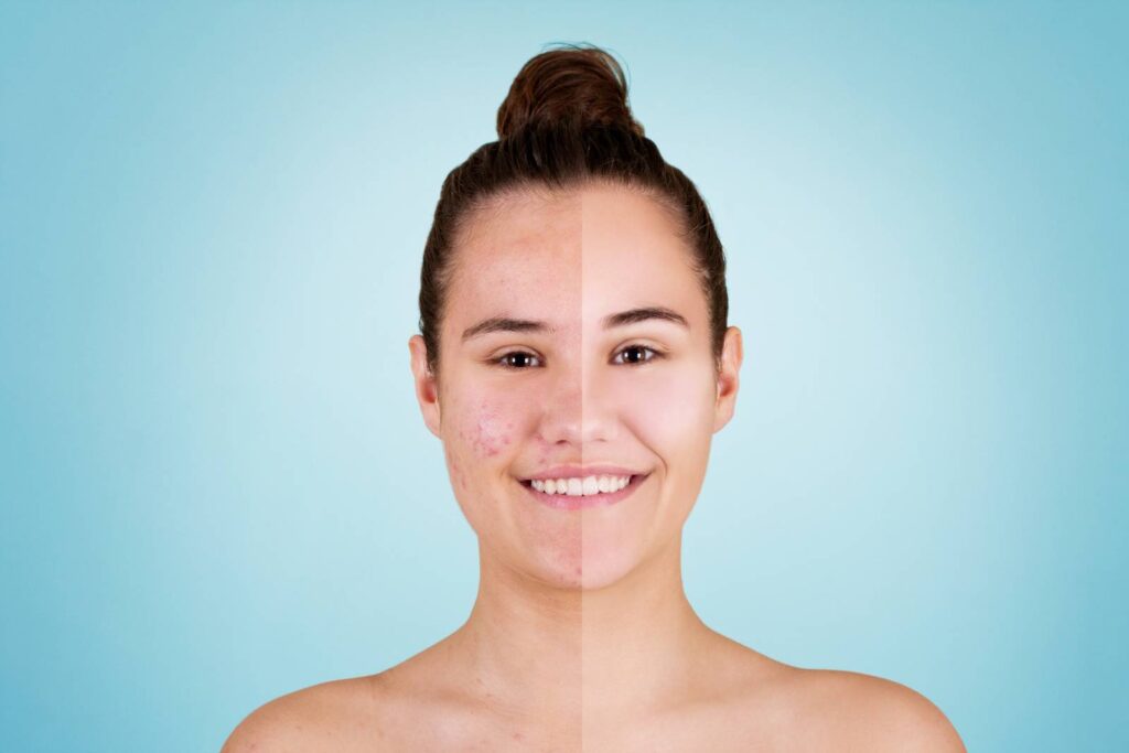 Split-screen image of a young woman’s face showing acne and blemishes on the left side and clear, smooth skin on the right side, representing the results of acne treatment.