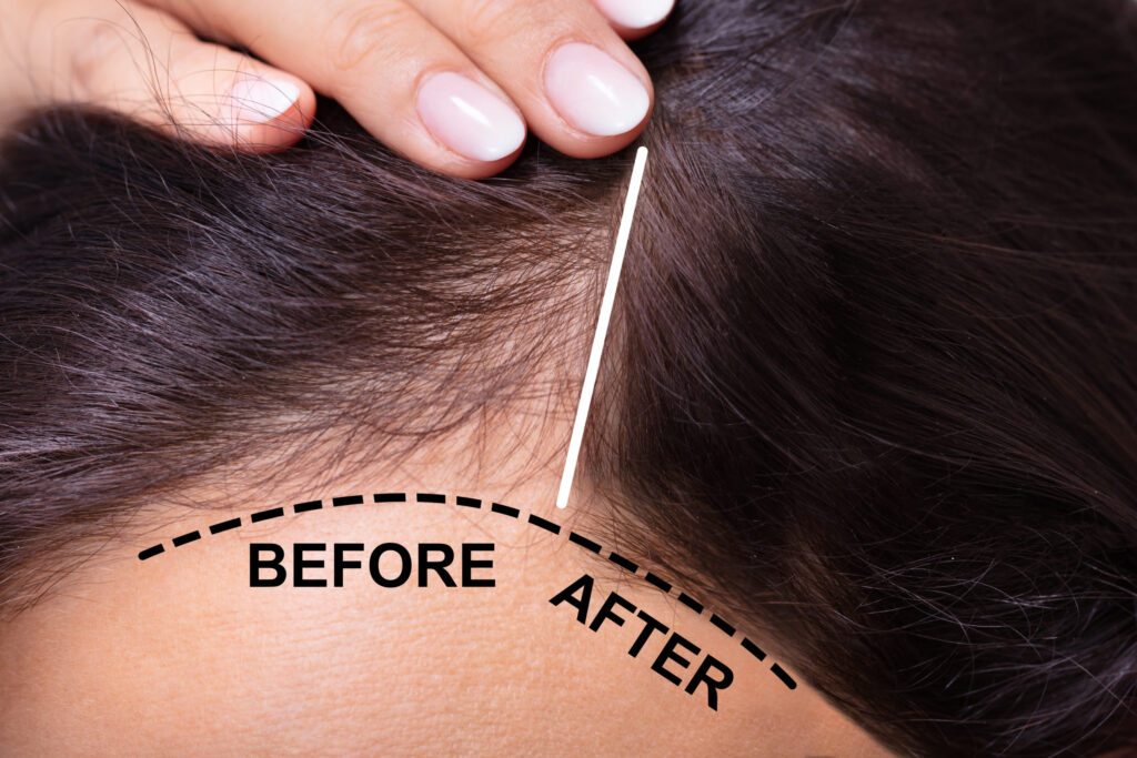 Close-up of a person's scalp showing a visual comparison of hair growth before and after PRF (Platelet-Rich Fibrin) treatment. A white dividing line and curved dashed labels highlight the receding hairline before and the fuller hairline after the procedure.