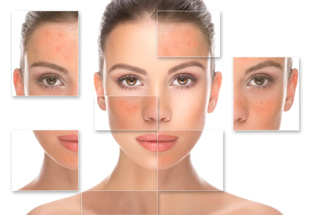 A digitally enhanced image of a woman's face surrounded by zoomed-in square overlays highlighting various skin conditions such as acne, redness, and pigmentation. The central portion of her face appears smoother and clearer, illustrating the effects of skincare or treatment like a chemical peel.