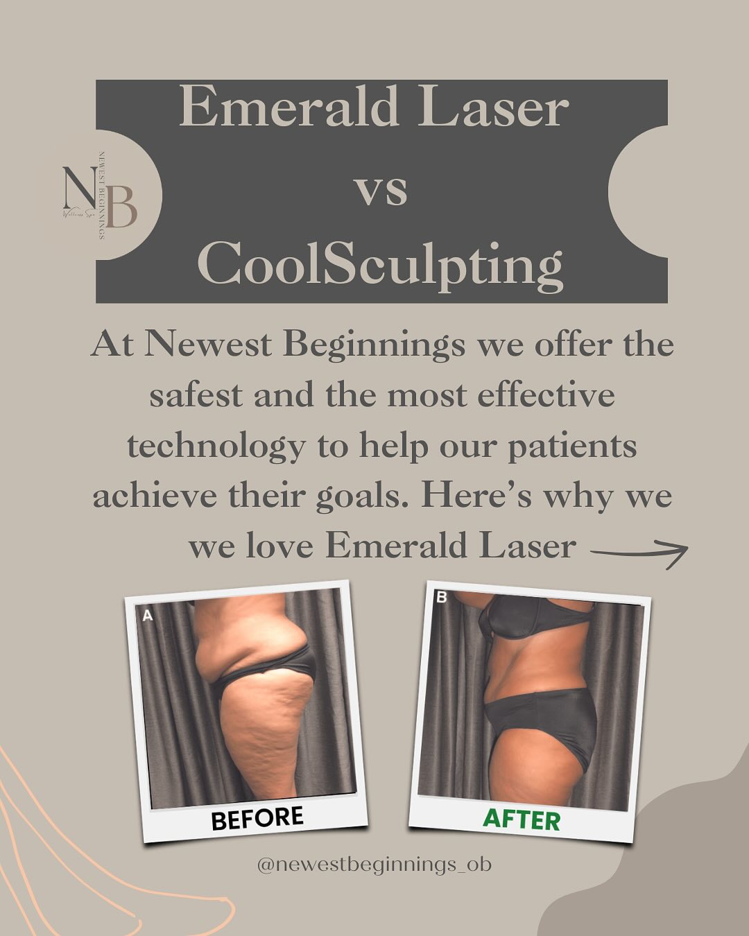 Emerald Laser VS CoolSculpting