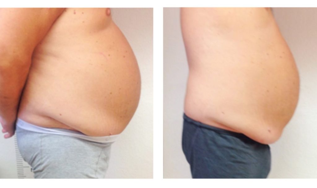 Side view before and after image of a man's abdominal area. The "before" photo shows a prominent, rounded belly with significant fat accumulation. The "after" photo displays a slightly reduced abdominal profile with smoother contour, suggesting early-stage progress from a body sculpting or fat reduction treatment.