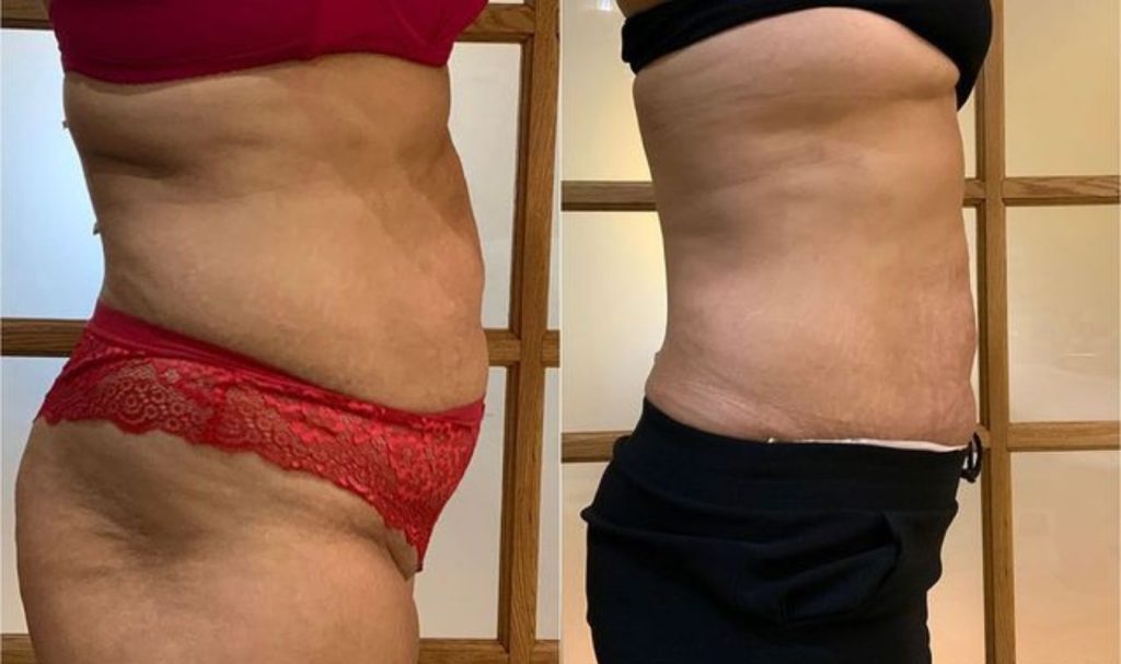 Side profile before and after image of a woman’s abdominal area. The "before" photo shows loose skin and a visible belly bulge. In the "after" image, the waistline is noticeably slimmer with smoother contours, indicating successful fat reduction and skin tightening.
