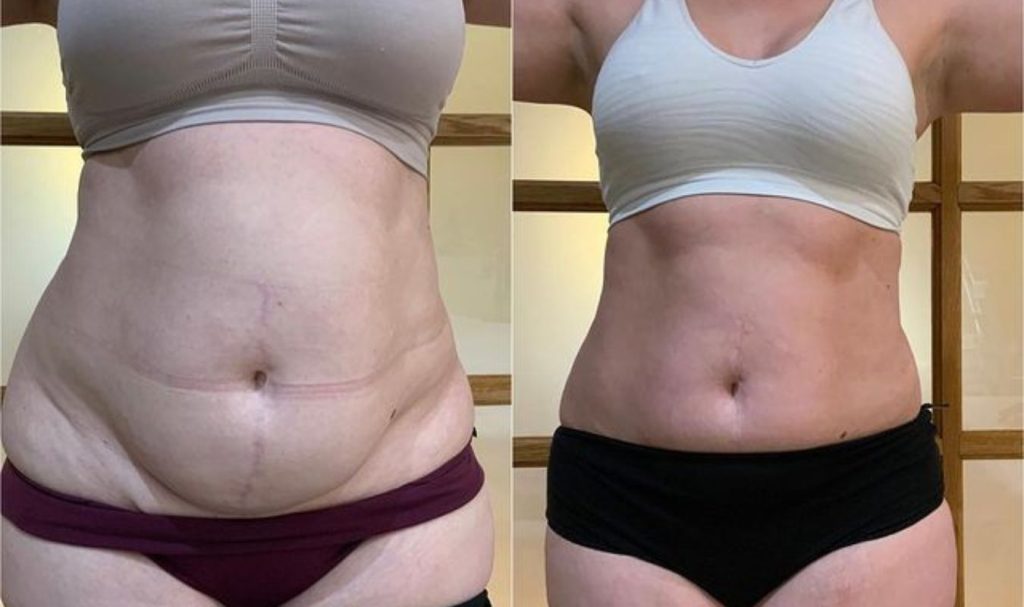 Front-facing before and after image of a woman’s abdomen. The "before" photo shows excess lower belly fat and skin folds. In the "after" photo, the stomach appears significantly flatter and firmer, with improved skin texture and tone, suggesting successful body contouring or post-pregnancy fat reduction treatment.