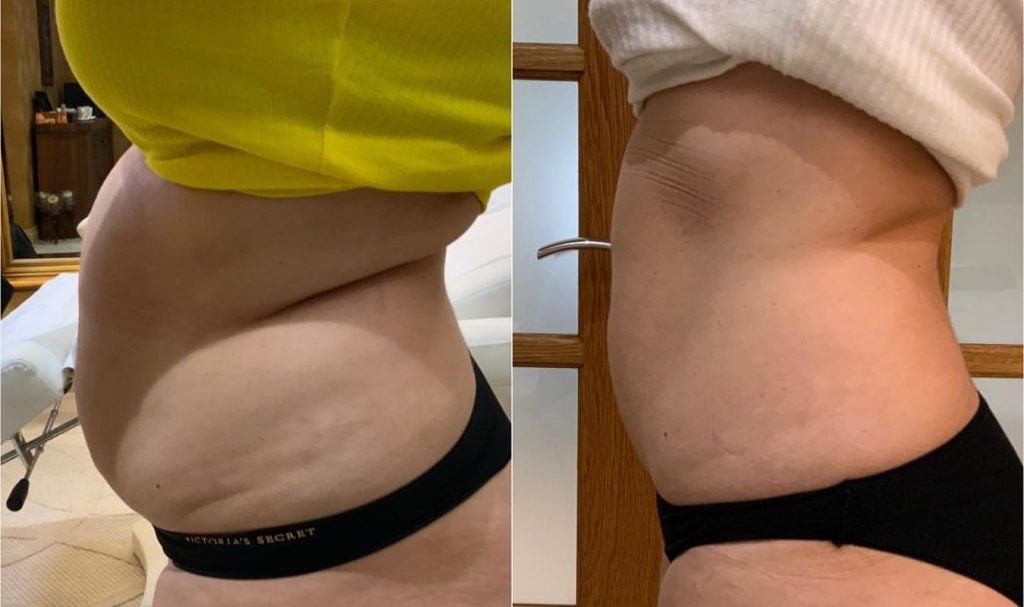 Side profile before and after photo of a woman’s midsection. The "before" image shows noticeable fat rolls and bulging in the abdominal area. The "after" image reveals a flatter, smoother waistline with significant reduction in fat, indicating a successful body sculpting or contouring treatment.