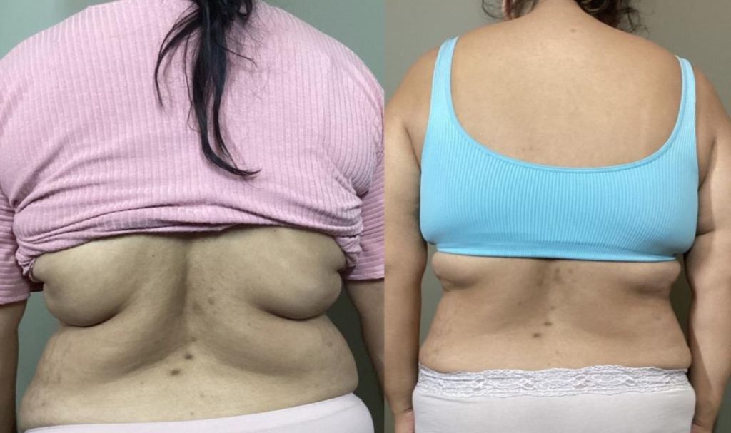 Rear view comparison of a woman’s back before and after body contouring. The "before" image shows prominent back fat and skin folds beneath the bra line. In the "after" image, the back appears smoother with visibly reduced bulges and improved definition, suggesting successful upper back fat reduction treatment.