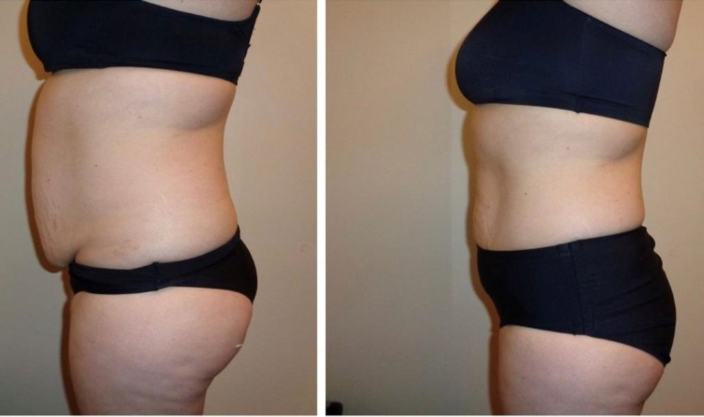 Side-by-side comparison of a woman’s abdomen before and after body contouring. The "before" image shows a visibly protruding lower belly with loose skin. In the "after" image, the abdominal area appears flatter and tighter, indicating successful fat reduction and skin toning.