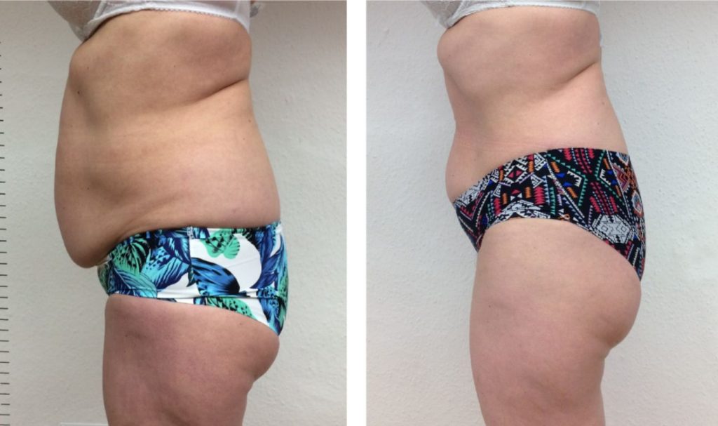 Side view before and after comparison of a woman's midsection. The "before" image on the left shows a prominent lower belly bulge and loose skin. In the "after" image on the right, her abdomen appears noticeably flatter with a smoother contour, suggesting effective fat reduction and body sculpting.