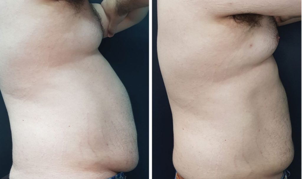 Side profile comparison of a man's abdomen before and after fat reduction treatment. The "before" photo on the left shows a protruding belly and visible lower abdominal fat. In the "after" photo on the right, the stomach appears significantly flatter and more contoured, suggesting effective non-surgical body sculpting.