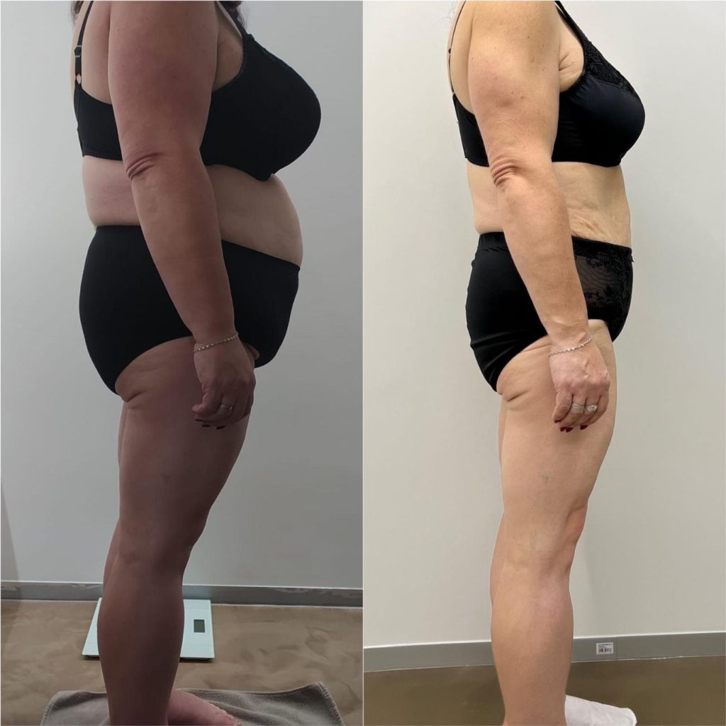 Side-by-side transformation of a woman shown from a side profile. In the "before" image on the left, there is visible abdominal fat, love handles, and fullness in the thighs. The "after" image on the right reveals a slimmer waistline, reduced belly fat, and more toned legs, suggesting successful body contouring or weight loss results.