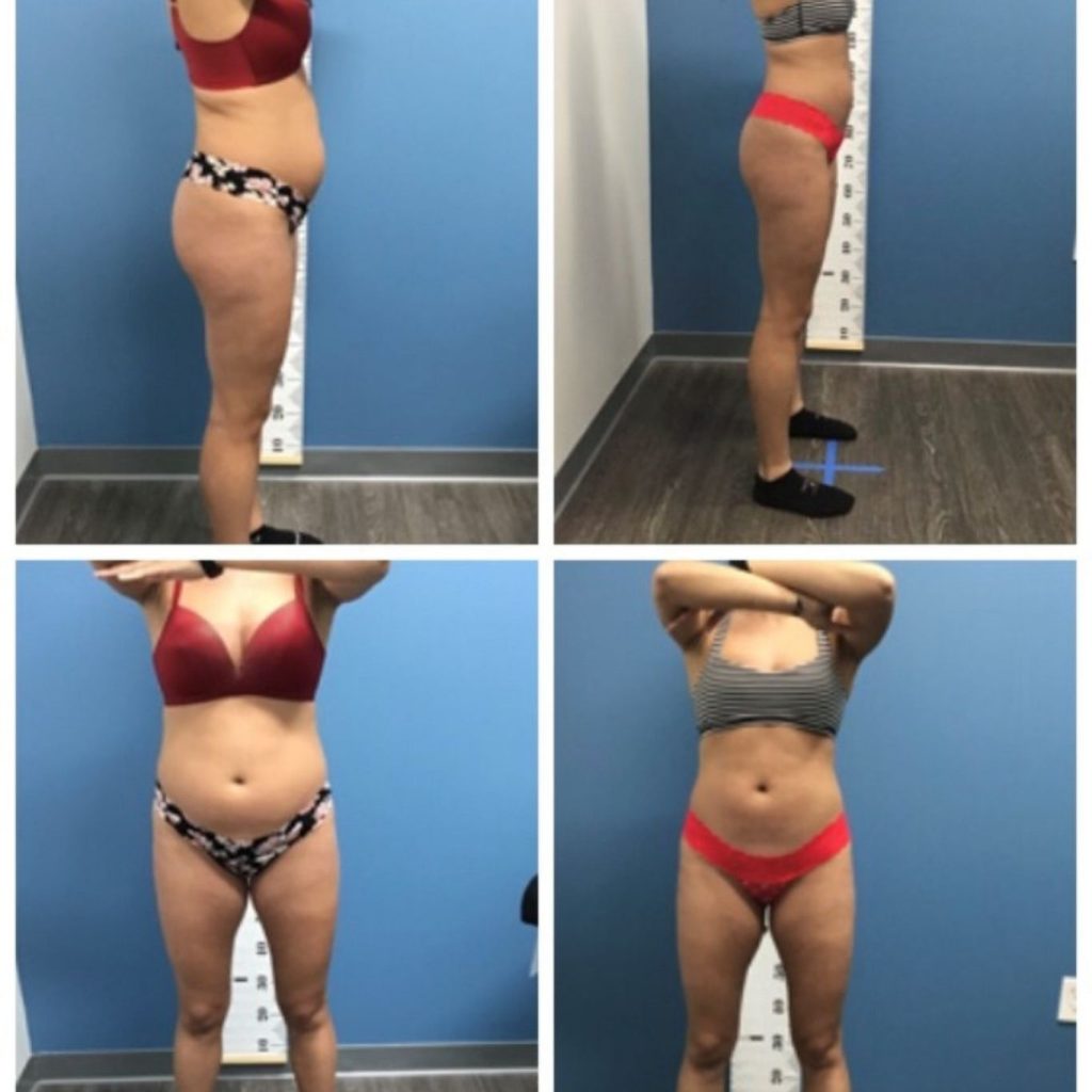 Before and after photos of a woman showing both side and front views of her body transformation. In the "before" images (left), there's visible abdominal bulge and thigh fullness. In the "after" images (right), her stomach appears flatter, waist more defined, and thighs more toned, suggesting effective body contouring or fat reduction treatment.