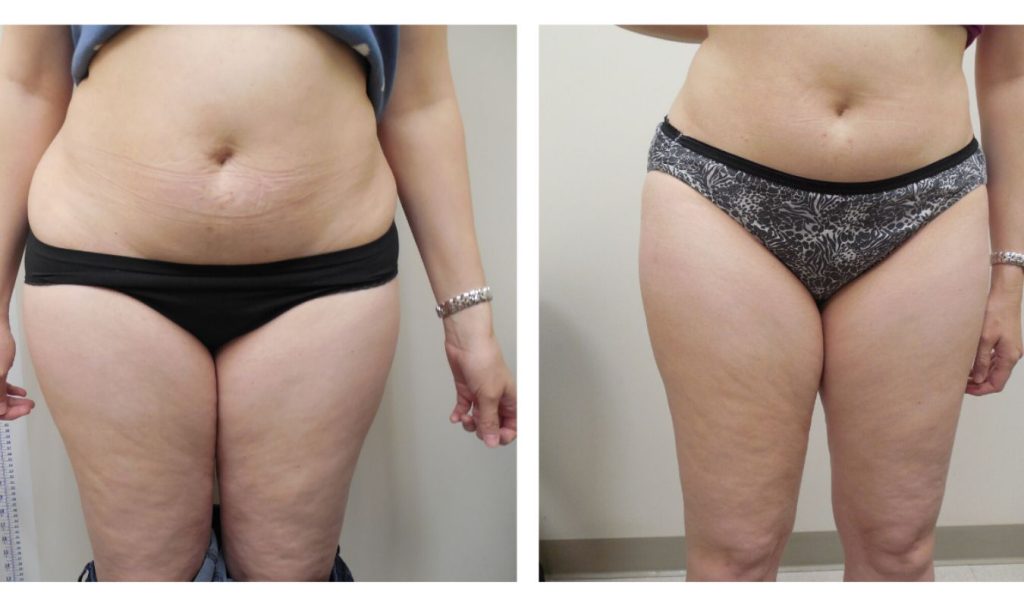 Front view before and after image of a woman’s abdomen and upper thighs. The "before" image shows loose skin, visible belly fat, and dimpling on the thighs. The "after" image shows a firmer midsection with improved skin texture and smoother thighs, indicating fat reduction and body contouring treatment.