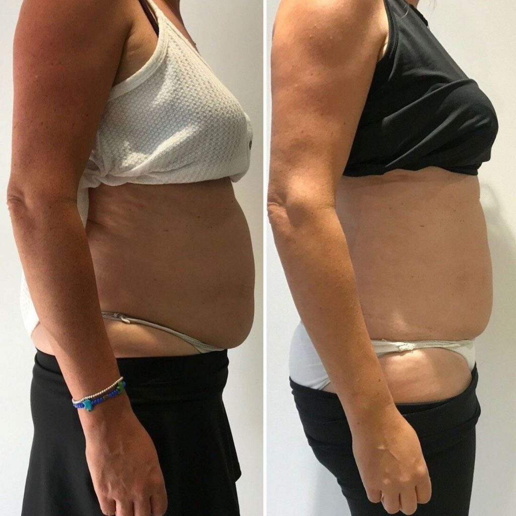 Side profile before and after image of a woman’s torso. The left photo shows a pronounced abdominal bulge and loose skin. In the right photo, the stomach appears flatter, with reduced fat and a more contoured waistline, indicating successful non-surgical body contouring or fat reduction.