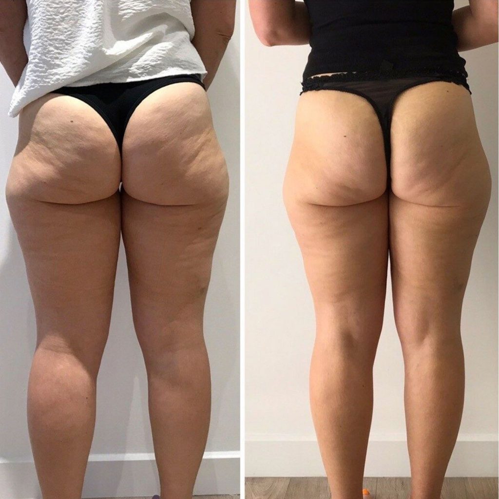 Rear view before and after image of a woman’s lower body. The "before" photo on the left shows visible cellulite, sagging skin, and fat accumulation on the buttocks and thighs. In the "after" photo on the right, the skin appears smoother and the overall contour of the buttocks and thighs is more lifted and toned, suggesting effective body sculpting or cellulite treatment.