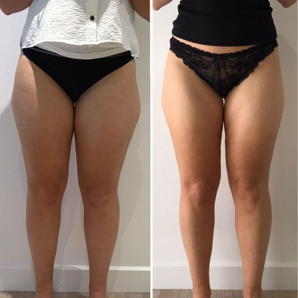 Full front view of a woman's lower body in a before and after comparison. In the "before" photo on the left, there is noticeable fullness and uneven contours around the inner thighs. In the "after" photo on the right, her thighs appear slimmer, smoother, and more toned, indicating successful fat reduction or body contouring treatment.