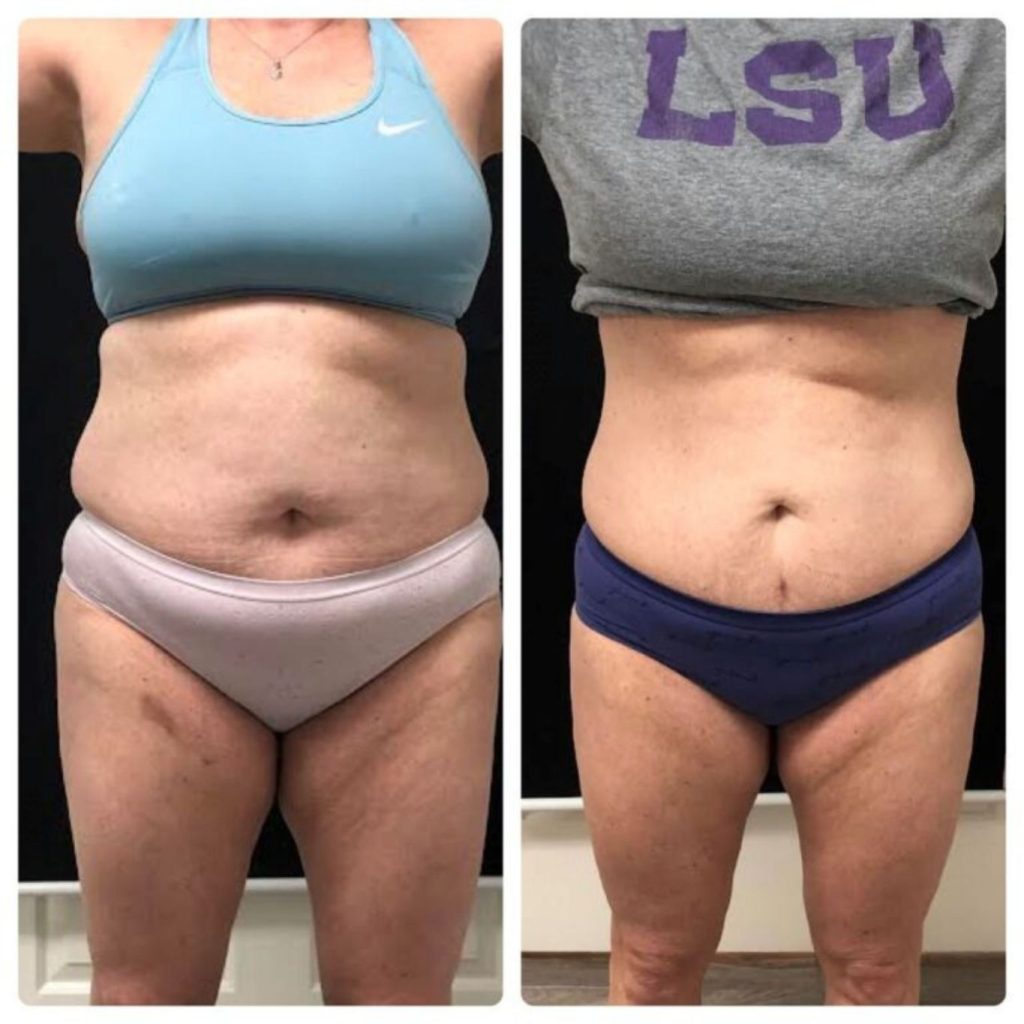 Before and after photo of a woman’s midsection transformation. In the left image, there is visible abdominal fat and loose skin around the stomach and hips. In the right image, her stomach appears flatter and more toned, showing noticeable fat reduction and improved contour.
