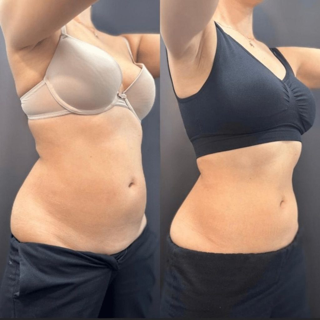 Side-by-side comparison of a woman's torso before and after body contouring. The "before" image on the left shows noticeable fat around the waist and lower abdomen. In the "after" image on the right, the midsection appears visibly slimmer and more toned, indicating fat reduction and improved skin smoothness.