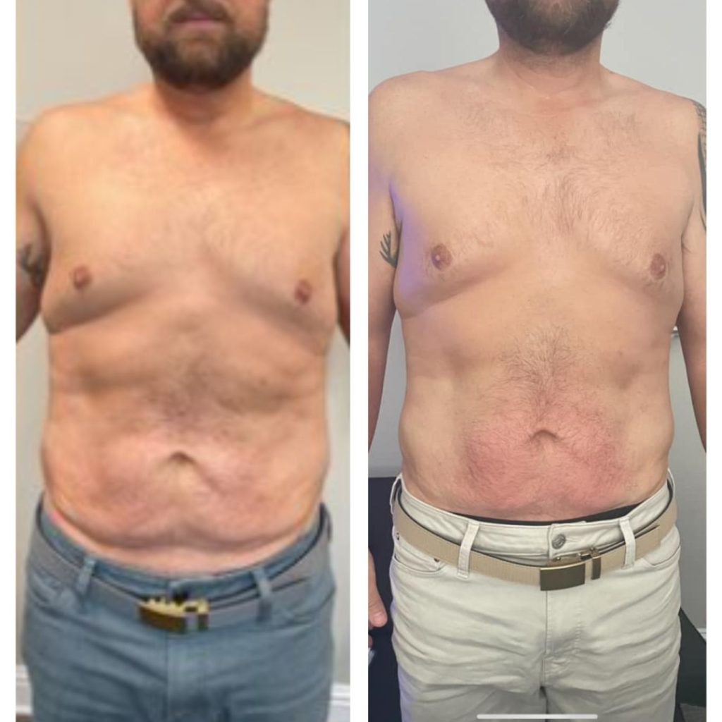 Before and after image showing a man's torso transformation. On the left, he has noticeable abdominal fat and loose skin; on the right, his stomach appears flatter, more toned, and less saggy, indicating body contouring or weight loss results.