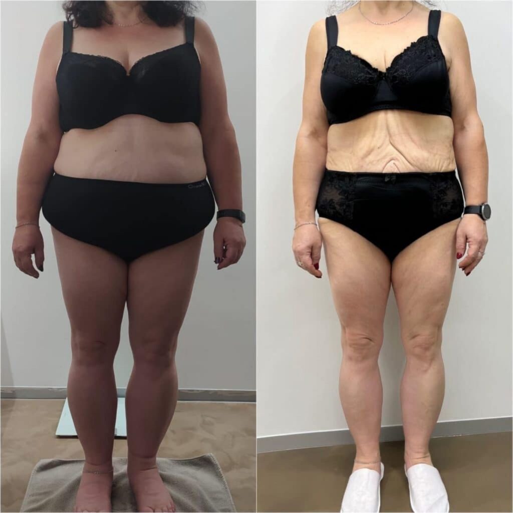 Front-facing before and after photos of a woman in black undergarments showing significant weight loss and body transformation. The left image presents a fuller figure, while the right image reveals a slimmer frame, looser skin, and more defined arms, waist, and legs.