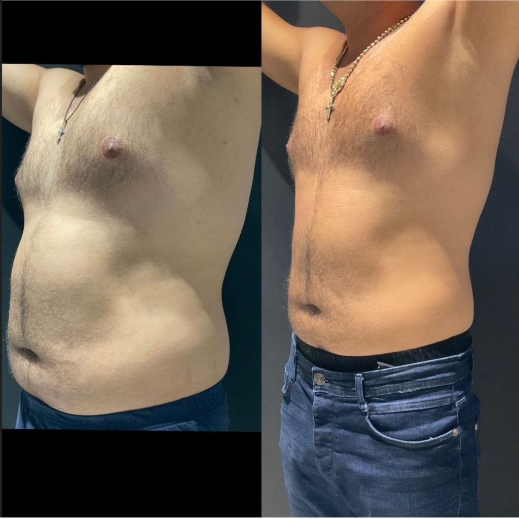 Side-by-side comparison of a man’s torso before and after a body contouring or fat reduction procedure. The left image shows a fuller midsection, while the right image reveals a noticeably flatter stomach and more defined waistline, both with arms raised for consistency.
