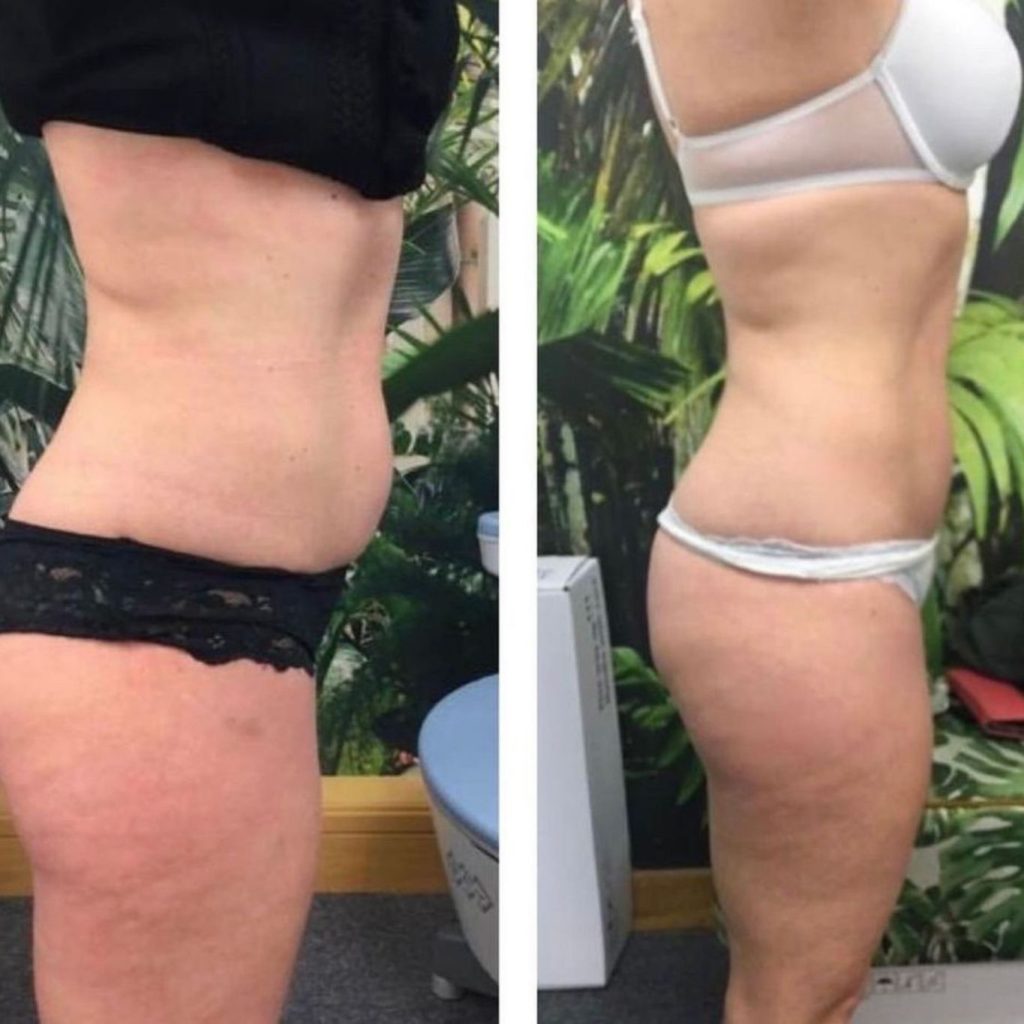 Side-by-side image of a woman in black and white undergarments showing visible changes in body shape after a contouring treatment. The left image displays a more pronounced lower abdomen and thighs, while the right image reveals a flatter stomach and smoother silhouette with improved definition.