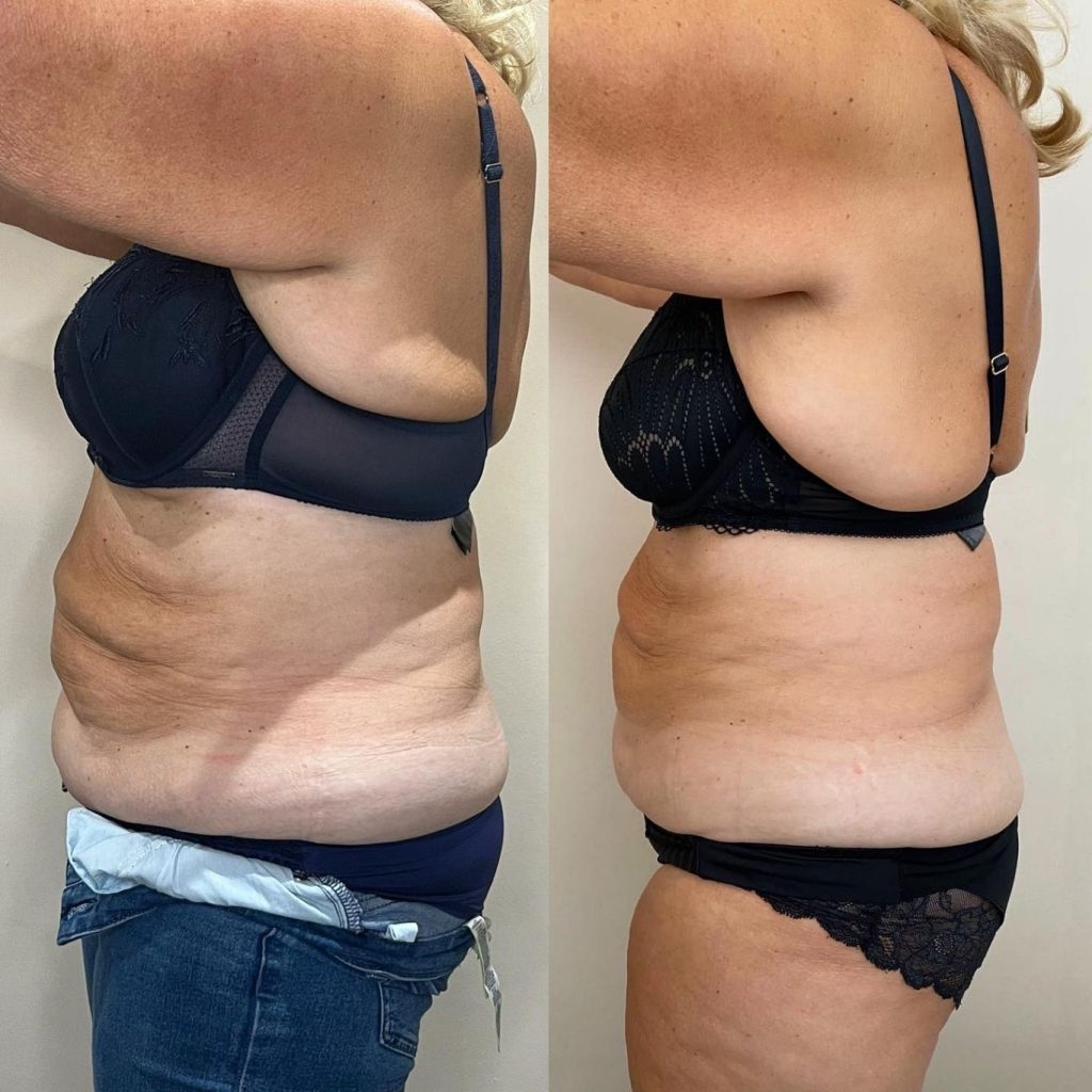 Side-by-side comparison of a woman’s torso from the side, showing a visible reduction in abdominal and waistline fat after a body contouring treatment. The left image shows more prominent rolls and loose skin, while the right image reveals a smoother, tighter silhouette with improved shape.