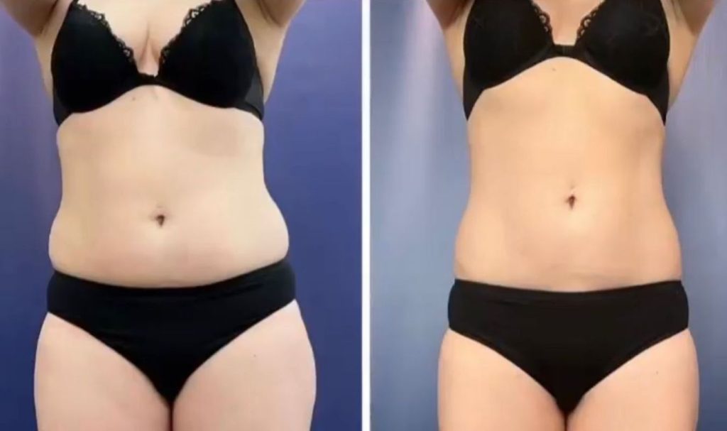 Front view before and after image of a woman’s midsection. The "before" photo shows a fuller abdomen and visible waist bulges. The "after" photo reveals a flatter stomach and a more contoured waistline, suggesting effective body sculpting or fat reduction treatment.