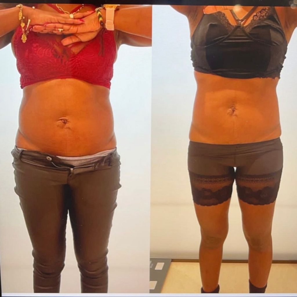 Side-by-side comparison of a woman’s torso and legs, showing noticeable improvement in abdominal tone and waistline after a body sculpting or slimming treatment. The left image displays a fuller midsection, while the right image shows a flatter, more defined appearance, with both taken under similar lighting and stance.
