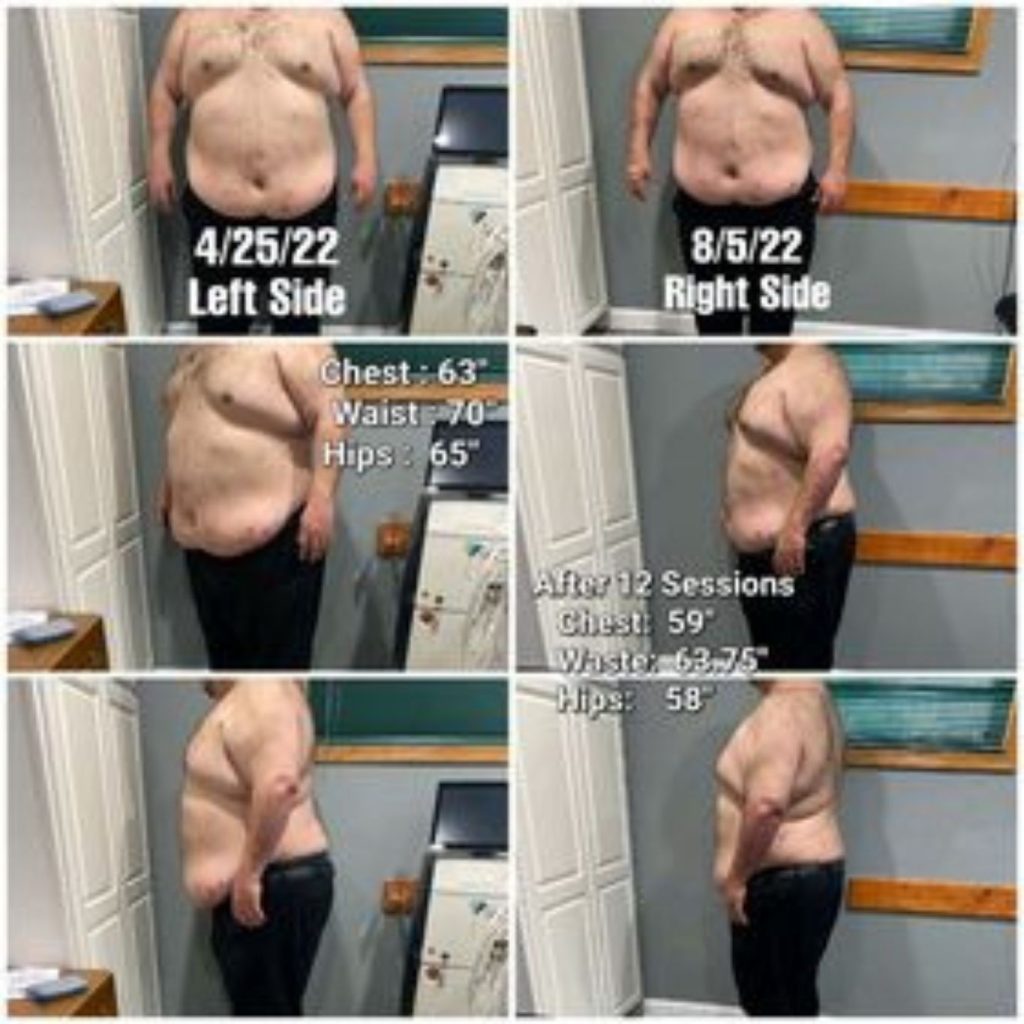 Before and after collage of a man's body transformation over 12 sessions. The "before" photos from 4/25/22 show a larger abdomen and chest with measurements: chest 63", waist 70", hips 65". The "after" photos from 8/5/22 show a visibly slimmer figure with reduced measurements: chest 59", waist 63.75", hips 58", highlighting significant progress in body sculpting and fat reduction.