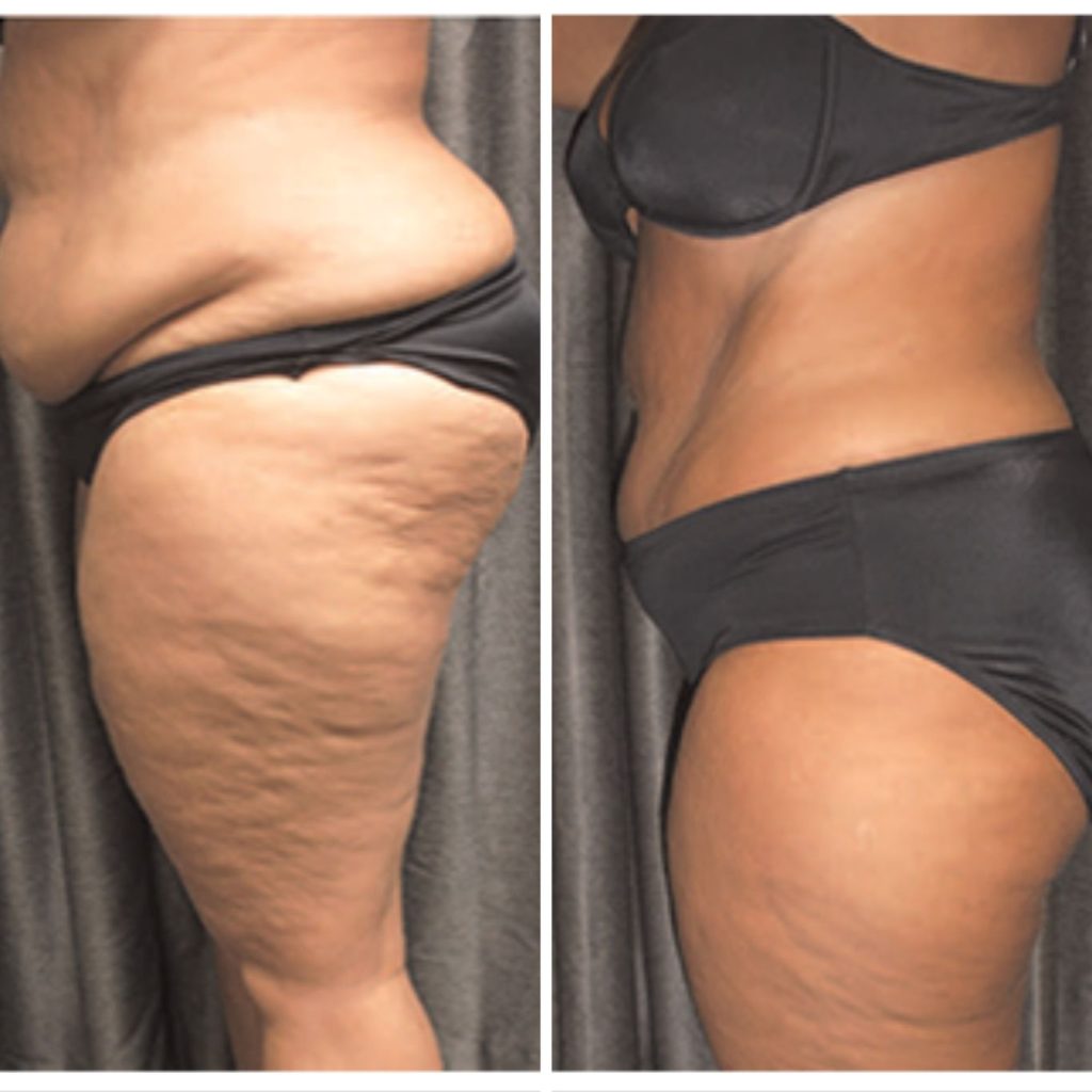Side-by-side before and after image showing a woman’s midsection, hip, and thigh area. The left image displays more prominent fat accumulation and skin texture, while the right image reveals a noticeably slimmer, smoother silhouette following body contouring treatment.