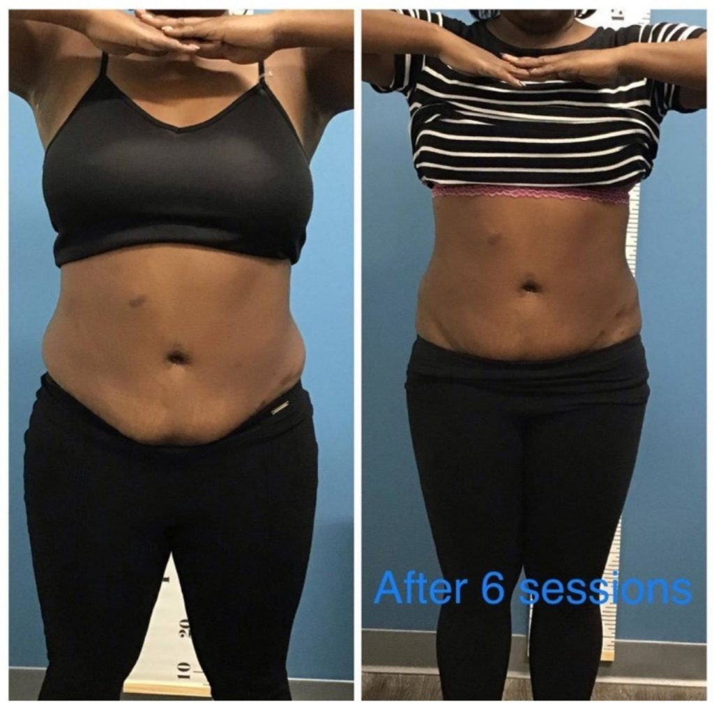 Side-by-side comparison of a woman’s midsection before and after six sessions of body slimming or contouring treatment, showing a visible reduction in abdominal fat and improved waistline definition, with both images taken in front of a height measurement wall.