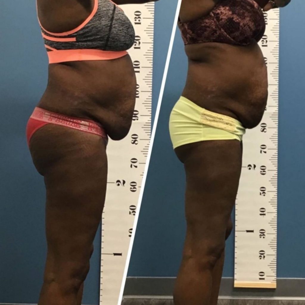 Side-by-side comparison of a woman before and after a non-invasive body contouring treatment, showing a visible reduction in abdominal size and improved silhouette, marked against a height measurement backdrop.