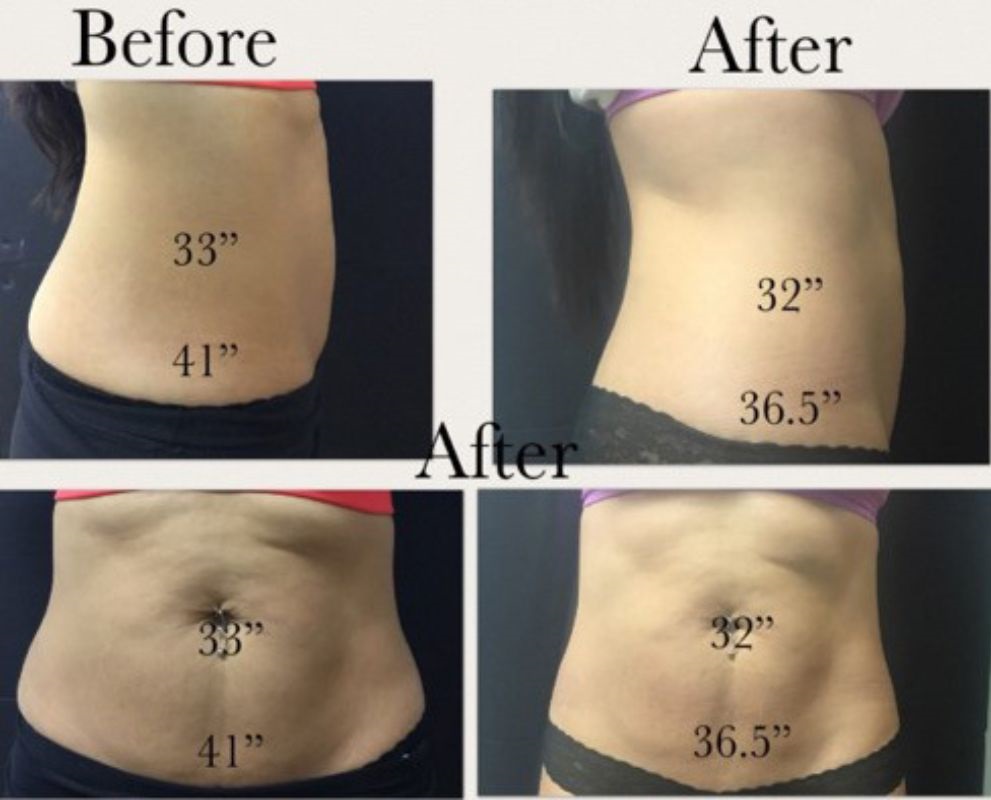 Waist and hip measurement reduction – before and after body sculpting with inch loss