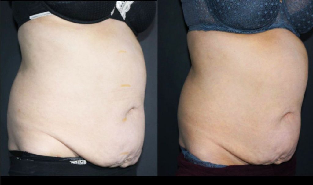 Side profile before and after image of a woman’s abdomen. The "before" photo shows visible abdominal fullness, skin laxity, and lower belly fat. The "after" image reveals a smoother contour with reduced bulge and improved skin appearance, indicating effective non-surgical fat reduction and skin tightening.