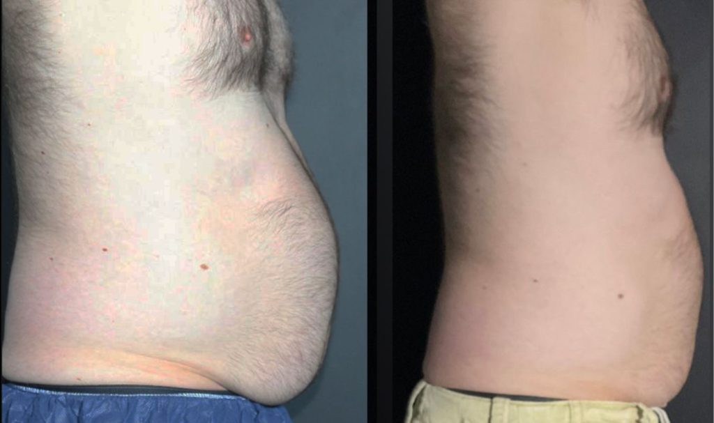 Side view before and after image of a man's midsection. The "before" photo shows a prominent belly bulge and excess abdominal fat. In the "after" photo, the stomach appears much flatter and more contoured, indicating a successful fat reduction or body sculpting treatment.