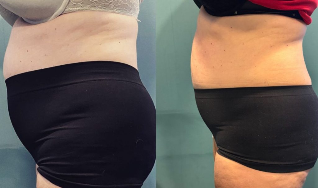 Side-by-side before and after image of a woman’s midsection. The "before" photo shows a rounded abdomen with visible fat accumulation. The "after" image reveals a flatter, more sculpted waistline and a smoother abdominal profile, indicating effective body contouring or fat reduction.