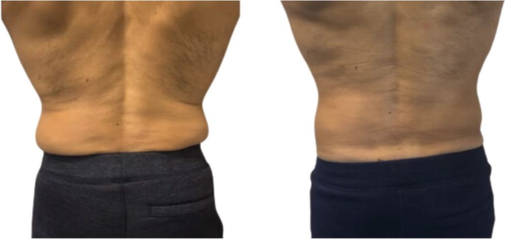 Rear view before and after image of a man's lower back. The "before" photo shows visible love handles and fat accumulation around the waist. In the "after" photo, the love handles are significantly reduced and the back appears leaner and more defined, suggesting effective fat reduction treatment.