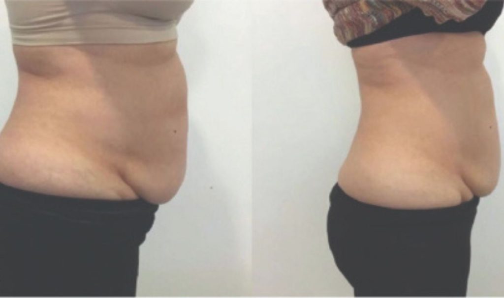 Side profile before and after image of a woman’s lower abdomen. The "before" photo shows a prominent lower belly pouch and sagging skin. The "after" photo reveals a flatter, more contoured waistline with reduced abdominal fullness, indicating successful fat reduction or skin tightening.